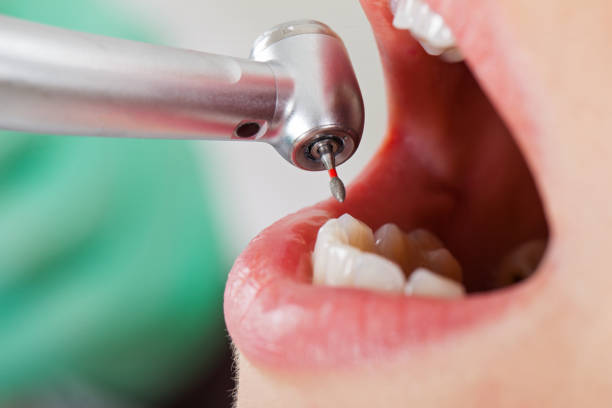 Best Emergency Wisdom Teeth Removal in Vernon, AL